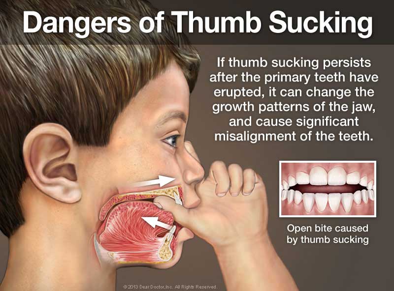 thumb sucking dangers